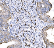 IHC staining of FFPE human endometrial adenocarcinoma tissue with 5HT1A Receptor antibody. HIER: boil tissue sections in pH8 EDTA for 20 min and allow to cool before testing.