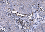 IHC staining of FFPE human lung cancer tissue with 5HT1A Receptor antibody. HIER: boil tissue sections in pH8 EDTA for 20 min and allow to cool before testing.