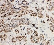 IHC-P: MCM2 antibody testing of human lung cancer tissue. HIER: steam section in pH6 citrate buffer for 20 min.