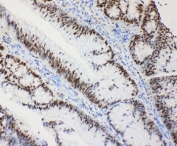 IHC-P: MCM2 antibody testing of human intestinal cancer tissue. HIER: steam section in pH6 citrate buffer for 20 min.