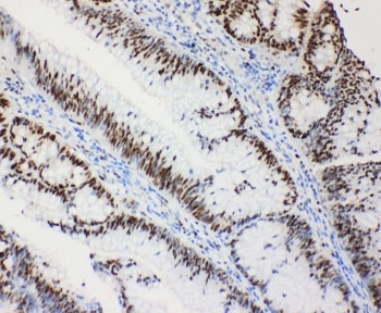 IHC-P: MCM2 antibody testing of human intestinal cancer tissue