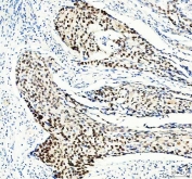 IHC staining of FFPE human cervical cancer tissue with MCM3 antibody. HIER: boil tissue sections in pH8 EDTA for 20 min and allow to cool before testing.