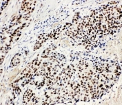 IHC-P: MCM3 antibody testing of human lung cancer tissue. HIER: steam section in pH6 citrate buffer for 20 min.