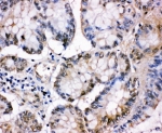 IHC-P: MCM5 antibody testing of human intestinal cancer tissue