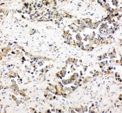 IHC staining of FFPE human lung cancer tissue with NDUFA1 antibody. HIER: boil tissue sections in pH6 citrate buffer for 20 min and allow to cool before testing.
