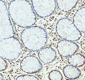 NLRP3 Antibody Colon Cancer IHC. Immunohistochemistry analysis of FFPE human colon cancer tissue stained with NLRP3 antibody. Predominantly cytoplasmic HRP-DAB brown staining is observed within stromal inflammatory-associated cellular populations adjacent to colonic epithelial structures, consistent with the established role of NLRP3 / Cryopyrin as an inflammasome-associated signaling protein involved in innate immune activation, inflammatory regulation, and cytokine maturation-associated cellular pathways. Tissue sections underwent HIER using pH 8 EDTA buffer prior to immunostaining.