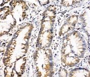 IHC-P: Oncostatin M antibody testing of human intestinal cancer tissue