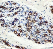 IHC staining of FFPE human breast cancer tissue with p65 antibody. HIER: boil tissue sections in pH8 EDTA for 20 min and allow to cool before testing.