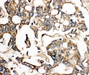 IHC-P: SLC10A1 antibody testing of human liver cancer tissue. HIER: steamed with pH6 citrate buffer.