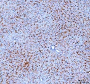 IHC-P: SLC10A1 antibody testing of human liver cancer tissue. HIER: steamed with pH6 citrate buffer.