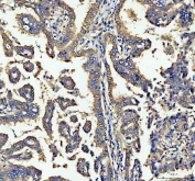 IHC staining of FFPE human lung cancer tissue with ALDH1A1 antibody. HIER: boil tissue sections in pH8 EDTA for 20 min and allow to cool before testing.