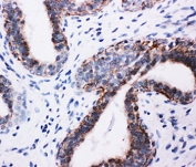 IHC-P: PI3K antibody testing of human breast cancer tissue. HIER: steamed with pH6 citrate buffer.