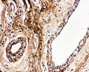 IHC-P: Protein C antibody testing of human breast cancer tissue