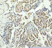 IHC staining of FFPE human lung cancer tissue with STAT6 antibody. HIER: boil tissue sections in pH8 EDTA for 20 min and allow to cool before testing.