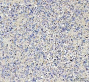 IHC staining of FFPE human glioma tissue with TNR antibody. HIER: boil tissue sections in pH8 EDTA for 20 min and allow to cool before testing.