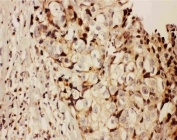 IHC testing of FFPE human breast cancer tissue with RFC1 antibody at 1ug/ml. Required HIER: steam section in pH6 citrate buffer for 20 min and allow to cool prior to staining.