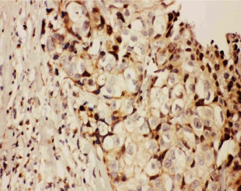 IHC testing of FFPE human breast cancer tissue with RFC1 antibody at 1ug/ml. Required HIER: steam section in pH6 citrate