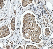IHC staining of FFPE human breast cancer tissue with SDHA antibody. HIER: boil tissue sections in pH8 EDTA for 20 min and allow to cool before testing.