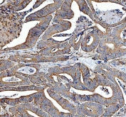 IHC staining of FFPE human rectum adenocarcinoma tissue with SDHA antibody. HIER: boil tissue sections in pH8 EDTA for 20 min and allow to cool before testing.
