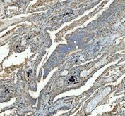 IHC staining of FFPE human lung cancer tissue with SDHA antibody. HIER: boil tissue sections in pH8 EDTA for 20 min and allow to cool before testing.