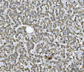 IHC staining of FFPE human liver cancer tissue with SDHB antibody. HIER: boil tissue sections in pH8 EDTA for 20 min and allow to cool before testing.