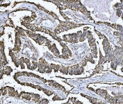 IHC staining of FFPE human lung adenocarcinoma tissue with SDHB antibody. HIER: boil tissue sections in pH8 EDTA for 20 min and allow to cool before testing.