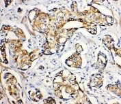 IHC-P: SERCA2 ATPase antibody testing of human breast cancer tissue