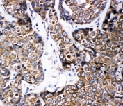 IHC-P: ABCB6 antibody testing of human breast cancer tissue