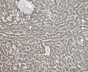 IHC testing of FFPE human liver cancer tissue with COX-2 antibody. HIER: boil tissue sections in pH8 EDTA for 20 min and allow to cool before testing.
