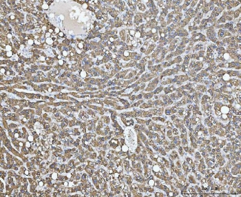 IHC testing of FFPE human liver cancer tissue with COX-2 antibody. HIER: boil tissue sections in pH8 EDTA for 20 min and allow to cool before testing.