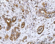 IHC testing of FFPE differentiated adenocarcinoma in human appendix tissue with COX-2 antibody. HIER: boil tissue sections in pH8 EDTA for 20 min and allow to cool before testing.