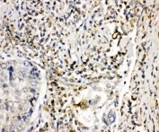 IHC-P: NOX1 antibody testing of human lung cancer tissue. HIER: steam section in pH6 citrate buffer for 20 min.