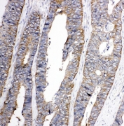 IHC-P: TRPC3 antibody testing of FFPE human rectal cancer tissue. Required HIER: steam section in pH6 citrate buffer for 20 min.