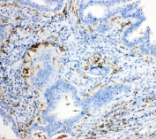 IHC-P: TRPC6 antibody testing of human intestinal cancer tissue