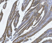 IHC staining of FFPE human rectal cancer tissue with YB1 antibody. HIER: boil tissue sections in pH8 EDTA for 20 min and allow to cool before testing.