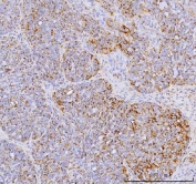 IHC staining of FFPE human ovarian cancer tissue with YB1 antibody. HIER: boil tissue sections in pH8 EDTA for 20 min and allow to cool before testing.