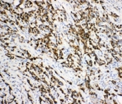IHC-P: DCI antibody testing of human breast cancer tissue. HIER: boil tissue sections in pH6, 10mM citrate buffer, for 10-20 min and allow to cool before testing.