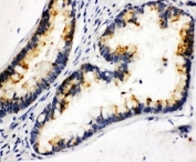 IHC-P: Kallikrein 6 antibody testing of human intestinal cancer tissue