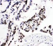 IHC-P: MCM6 antibody testing of human intestinal cancer tissue. HIER: steamed with pH6 citrate buffer.