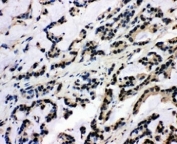 IHC-P: SNRPN antibody testing of human intestinal cancer tissue