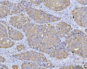 IHC staining of FFPE human liver cancer tissue with VDAC1 antibody. HIER: boil tissue sections in pH8 EDTA for 20 min and allow to cool before testing.
