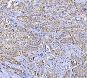 IHC staining of FFPE human urothelial carcinoma tissue with VDAC1 antibody. HIER: boil tissue sections in pH8 EDTA for 20 min and allow to cool before testing.