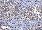 IHC staining of FFPE human lung cancer tissue with VDAC1 antibody. HIER: boil tissue sections in pH8 EDTA for 20 min and allow to cool before testing.
