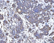 IHC staining of FFPE human ovarian cancer tissue with VDAC1 antibody. HIER: boil tissue sections in pH8 EDTA for 20 min and allow to cool before testing.