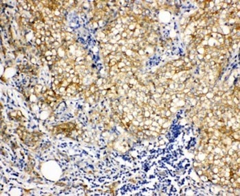 IHC-P: Vinculin antibody testing of human breast cancer tissue