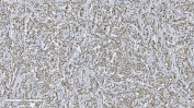 IHC staining of FFPE human lymphadenoma tissue with Aryl hydrocarbon Receptor antibody. HIER: boil tissue sections in pH8 EDTA for 20 min and allow to cool before testing.