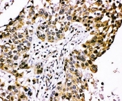 IHC staining of FFPE human lung cancer tissue with CISH antibody. HIER: boil tissue sections in pH8 EDTA for 20 min and allow to cool before testing.