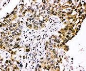 IHC-P: CISH antibody testing of human lung cancer tissue.