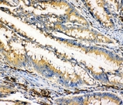 IHC-P: HEXA antibody testing of human intestinal cancer tissue.