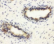 IHC-P: HLA-DM antibody testing of human breast cancer tissue